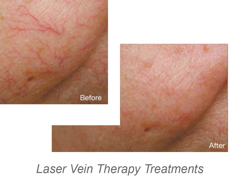 Vein Therapy Treatments Bolton