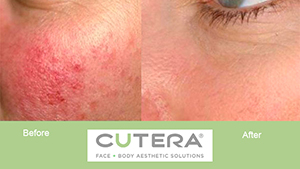 before and after photographs after laser genesis skin rejuvenation