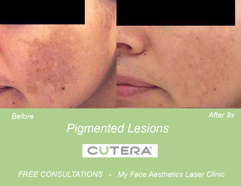 pigmented lesion treated at my face laser clinic bolton