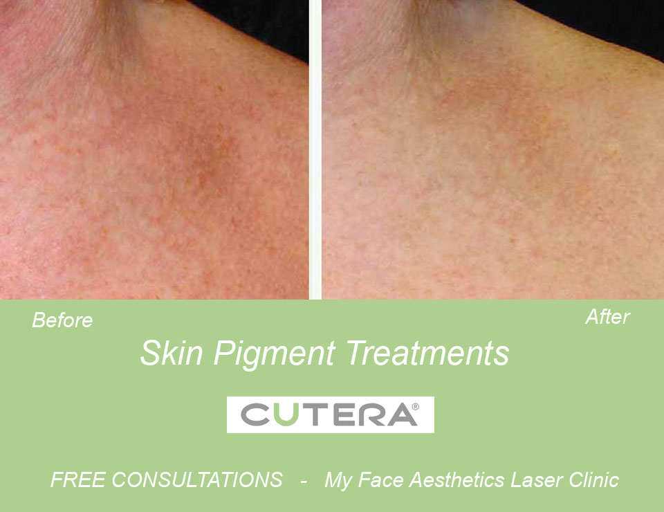 IPL treatment in the treatment of pigmented lesions in My Fce Bolton Laser Clinic