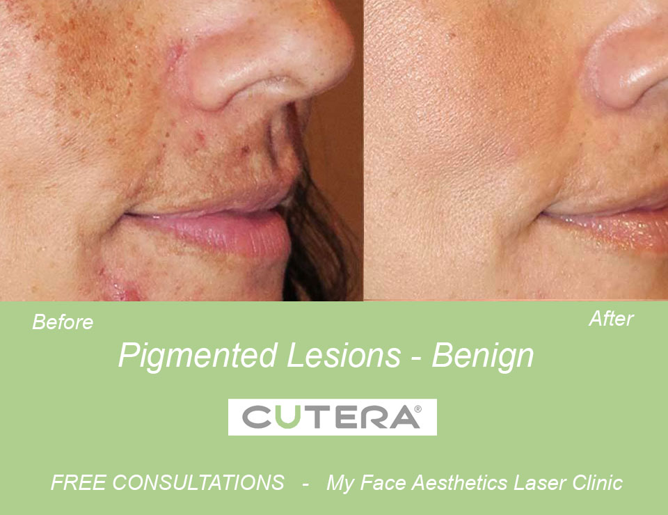 Benign lesion treated with Cutera Laser vein therapy Bolton