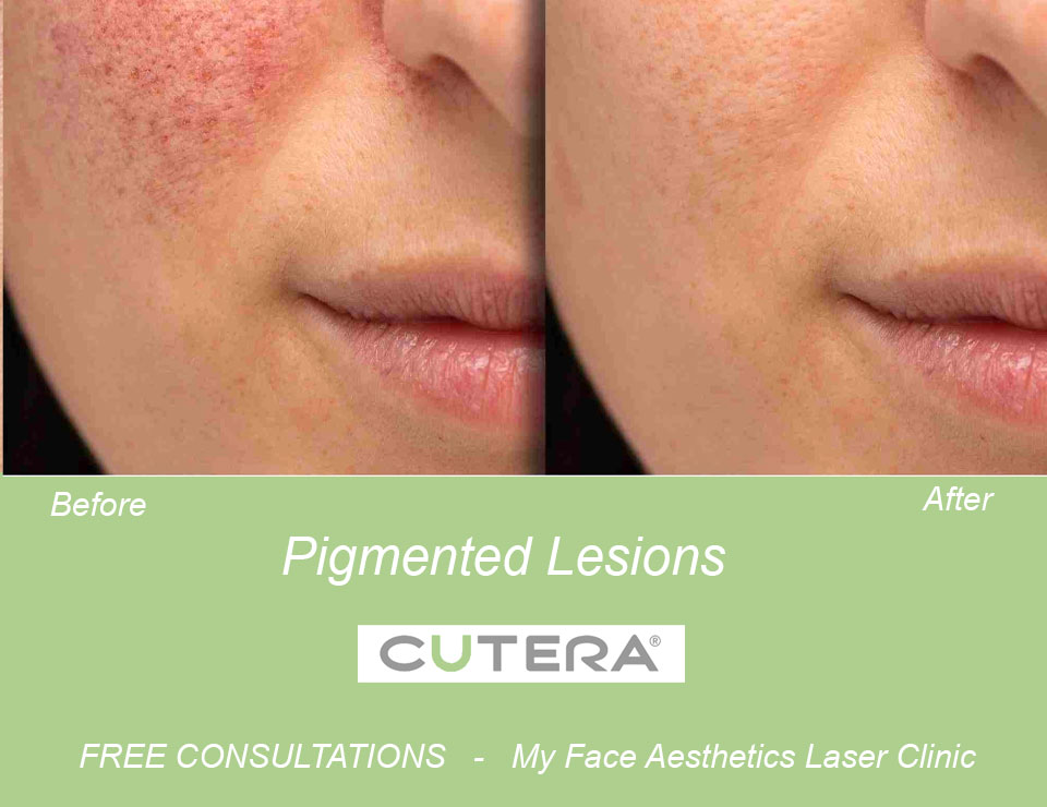 Pigmentation lesions treated with limelight ipl pigmentation therapy 