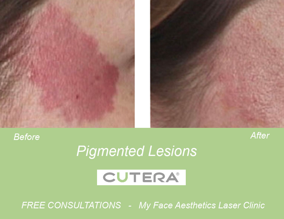 laser treatment in the treatment of pigmented lesion in My Fce Bolton Laser Clinic