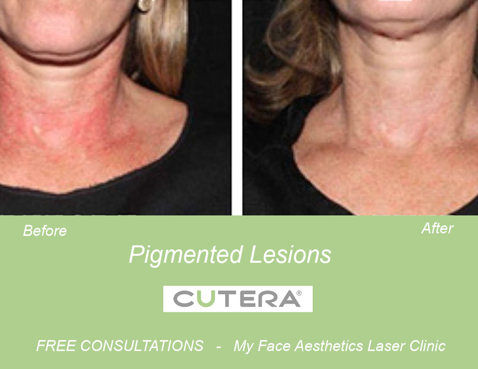 neck pigmentation treated with laser pigmentation therapy 