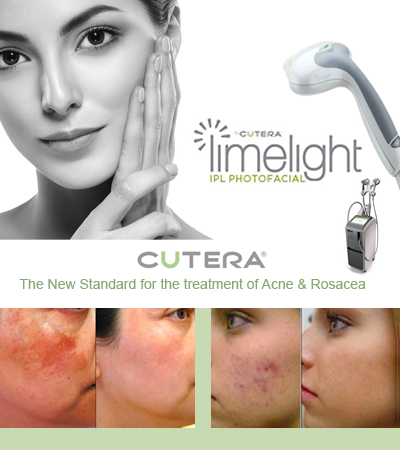 before and after photograph of Cutera Laser treatment of Acne and Rosacea using the laser Limelight