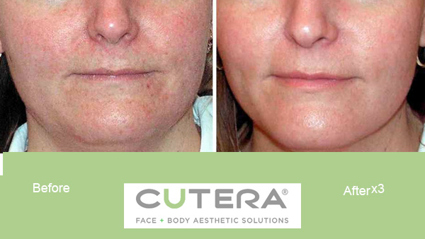before and after facial skin tightening with laser genesis