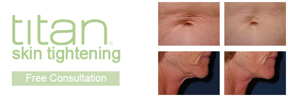 skin tightening before and after images using Cutera skin tightening showing stomach tightening and jaw and neck skin tighening