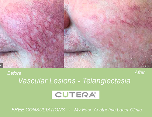 Vascular Lesions - Telangiectasia treated at my face laser clinic bolton