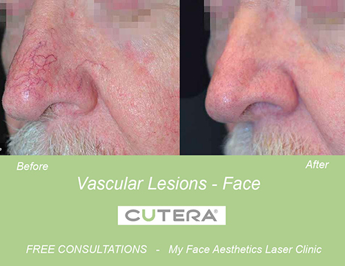 face vascular lesion treated with Cutera Laser vein therapy Bolton