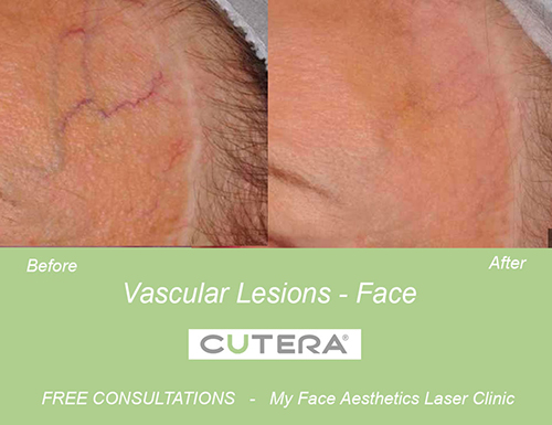 laser treatment in the treatment of spider veins in Bolton Clinic