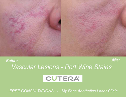 port wine stain treated with laser vein therapy 